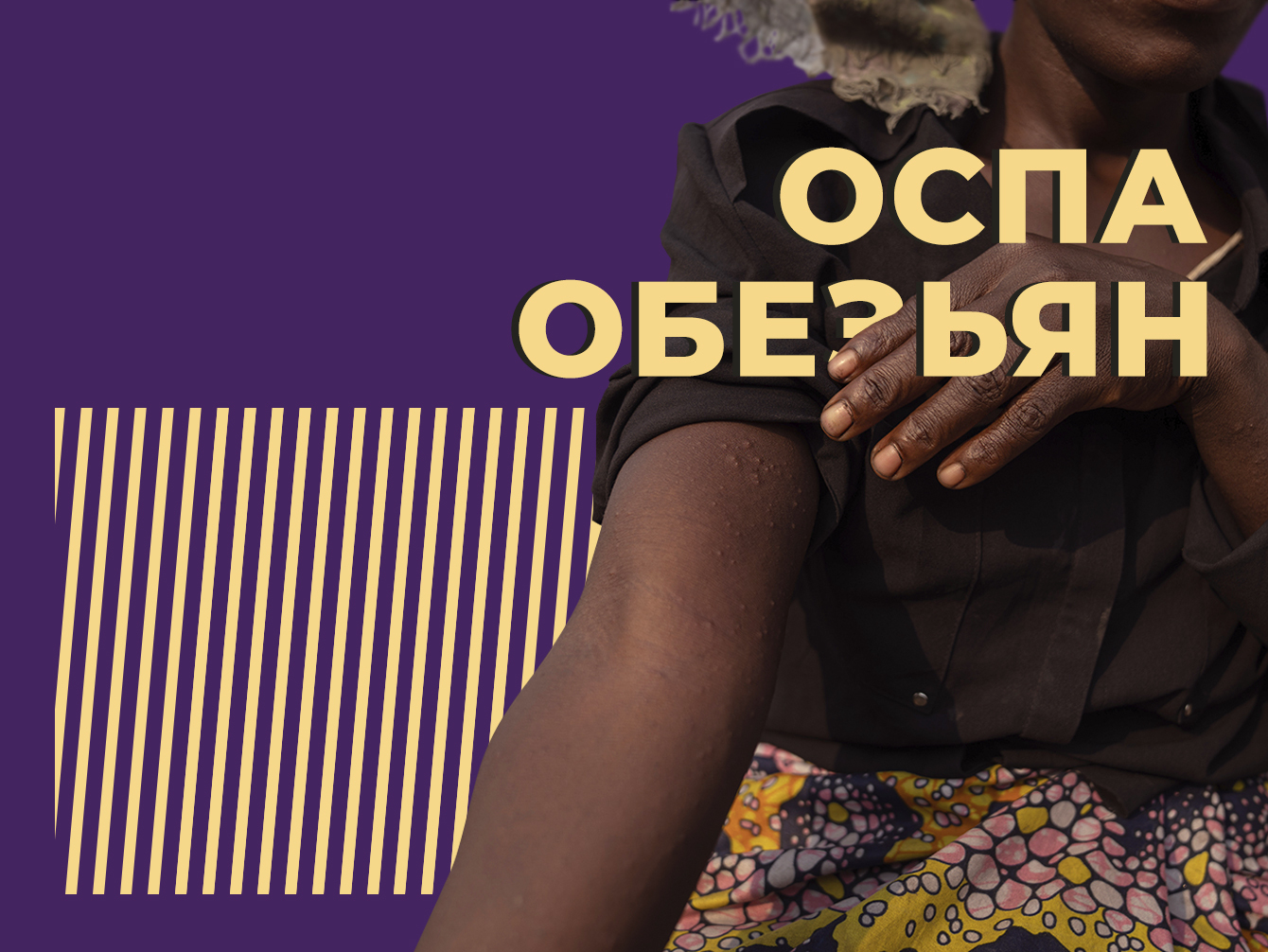 Что такое оспа обезьян и почему её сравнивают с ВИЧ. Объясняем простыми словами