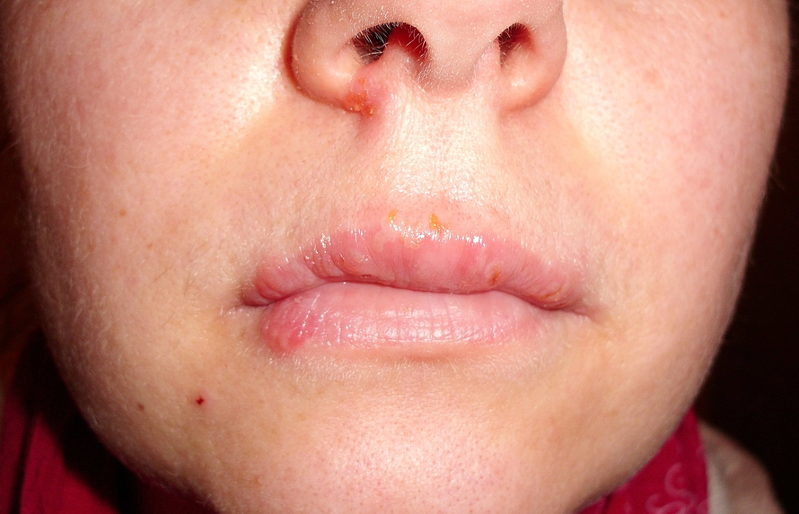 Не перепутай! Онколог объяснила, когда герпес — признак рака или СПИДа