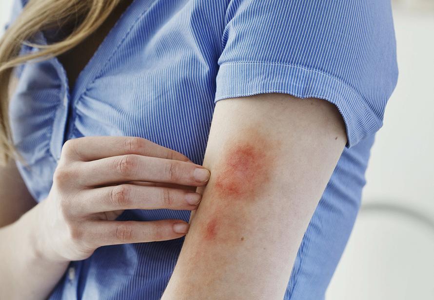 Врач рассказал, почему появляются синяки на теле. Придётся присмотреться к печени