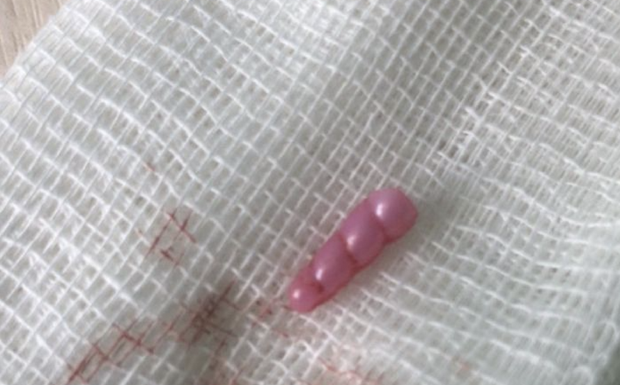 Рог единорога удалили из лба 7-летней россиянки. Она жила с ним два года